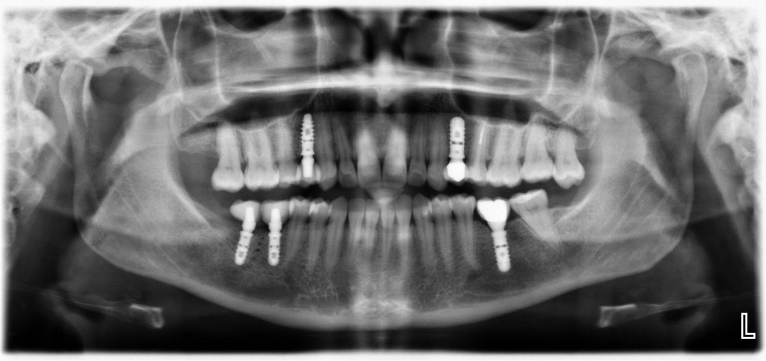 Impianti Dentali a Firenze